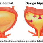 Leia mais sobre o artigo Alterações na bexiga após uma lesão na medula espinhal