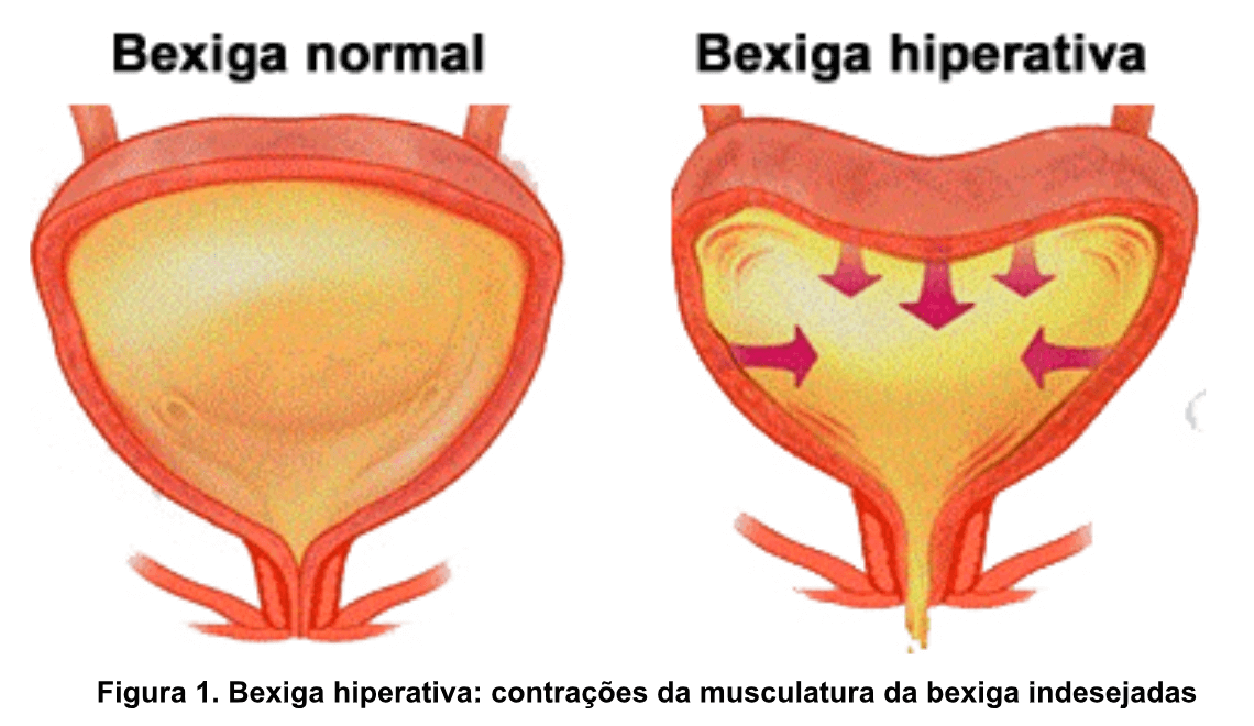 No momento, você está visualizando Alterações na bexiga após uma lesão na medula espinhal